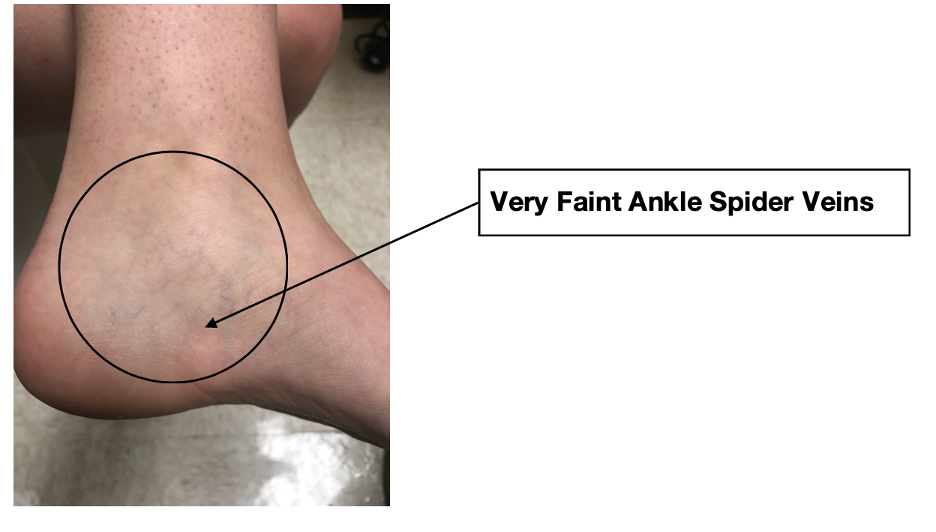 what-to-look-for-ankle-and-spider-veins