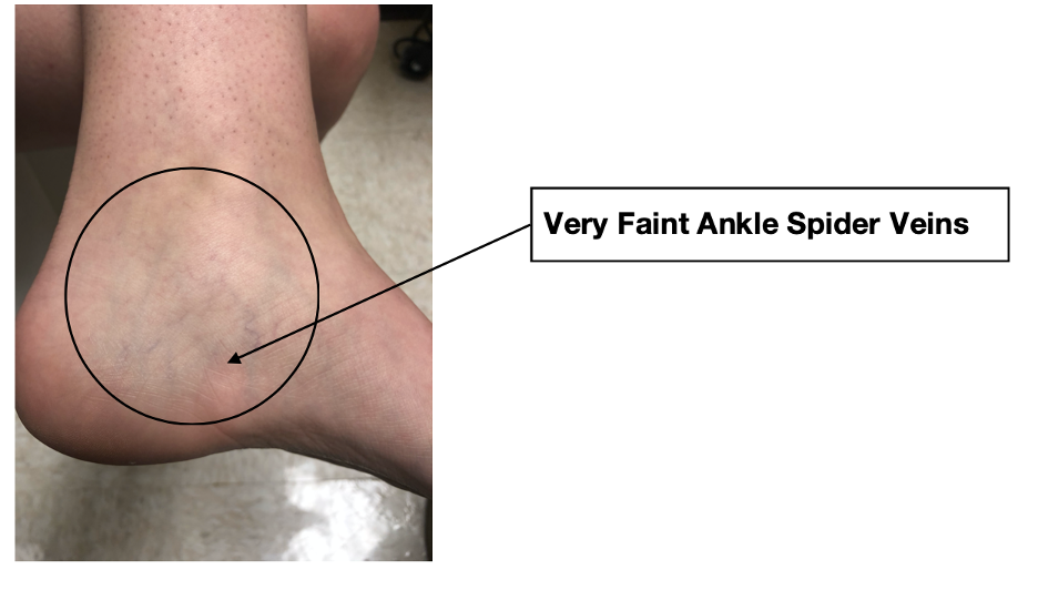 What to look for Ankle and Spider Veins