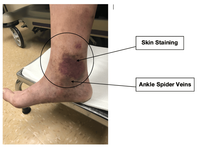 #10-skin-staining-and-ankle-spider-veins