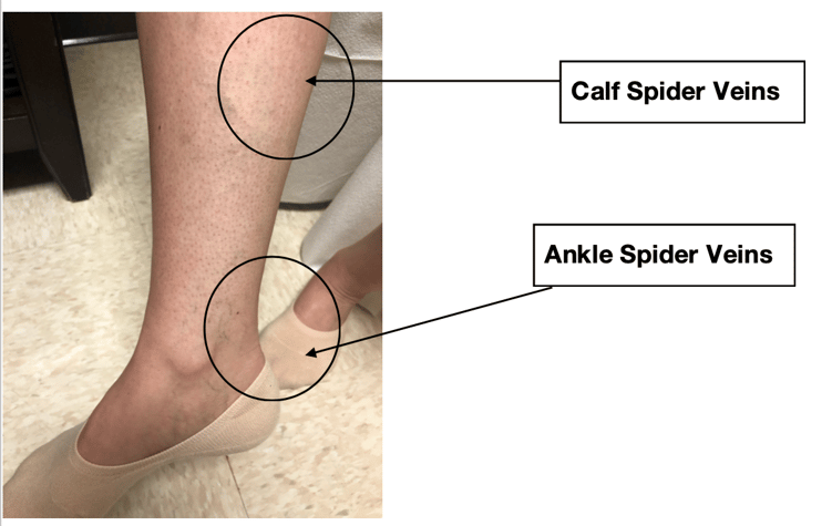 #2-ankle-and-calf-spider-veins