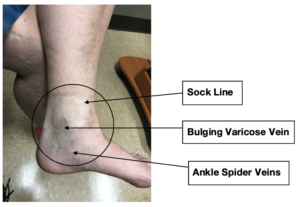 What to look for Sock line, ankle spider veins and bulging varicose veins