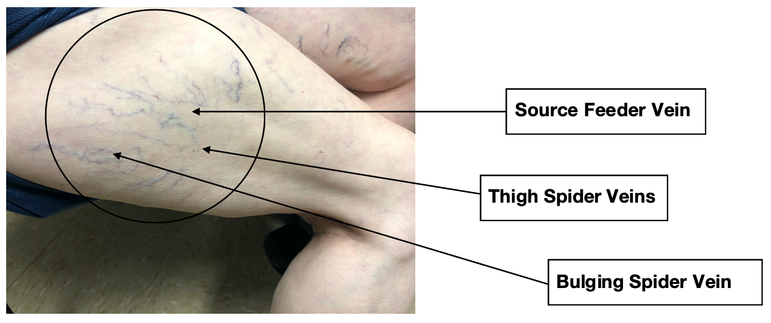 What to look for Thigh spider veins, bulging spider vein, source