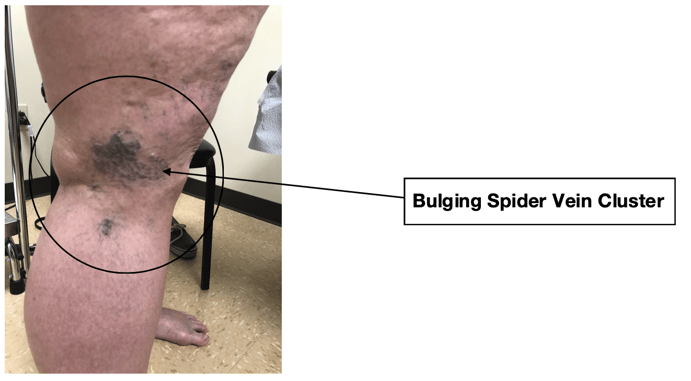 #5-bulging-spider-vein-cluster
