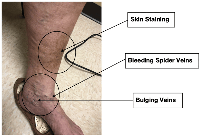 #6-skin-staining-bleeding-spider-vein-bulging-vein