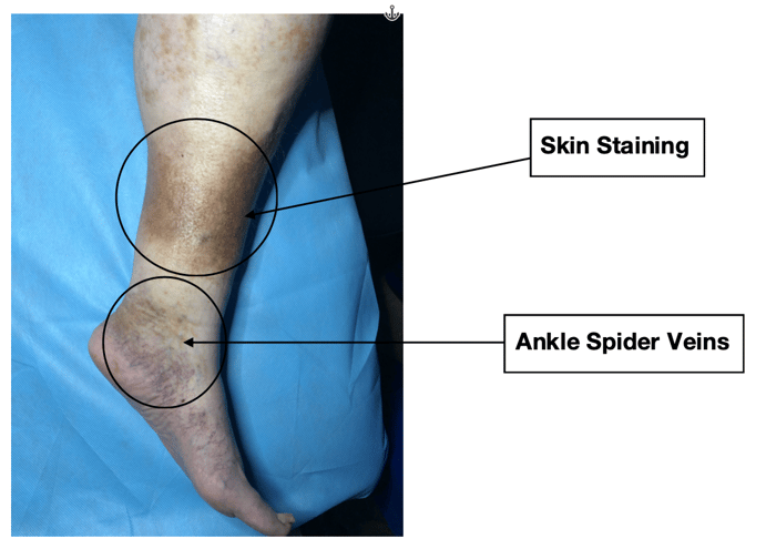 #7-ankle-spider-veins-and-skin-staining