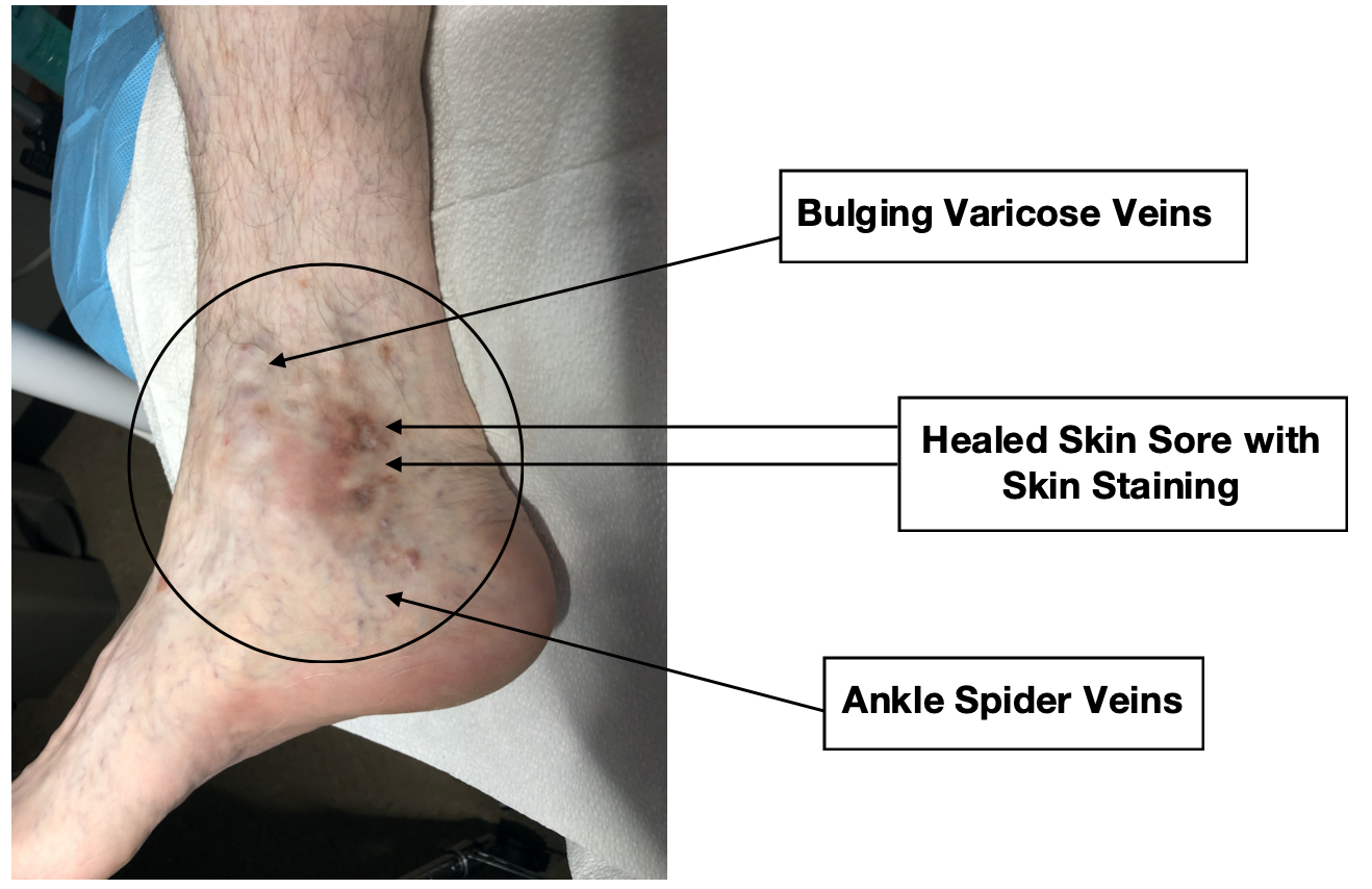 What to look for 8 Spider Veins Skin Sore Staining Bulging Varicose Veins