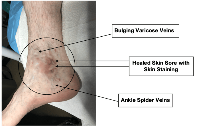 #8-ankle-spider-veins-healed-skin-sore-with-skin-staining-bulging-varicose-veins