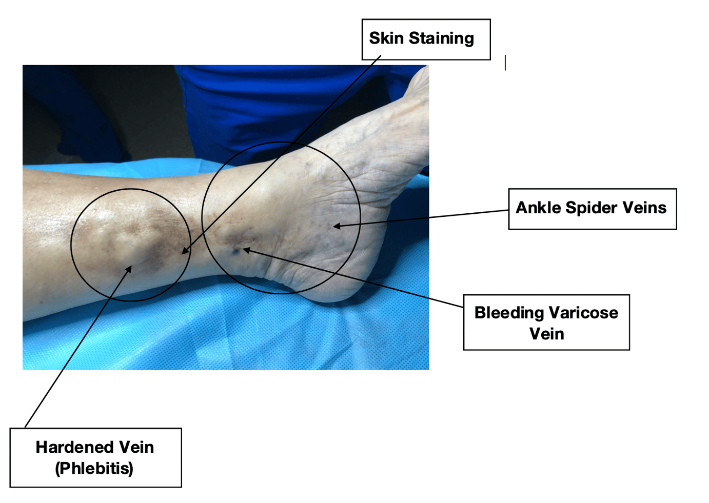 What to look for A Hardened Vein Phlebitis