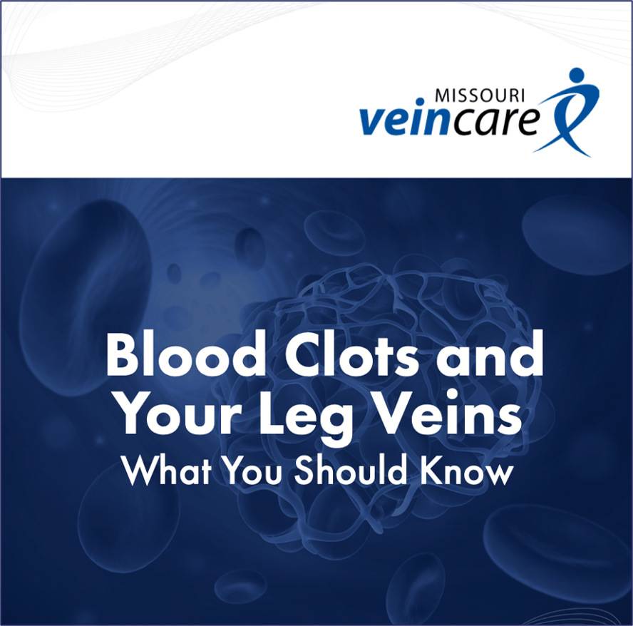 Blood Clots and Your Leg Veins What You Should Know