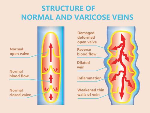 Graph-showing-the-difference-between-a-normal-vein-and-a-vein-with-vein-reflux